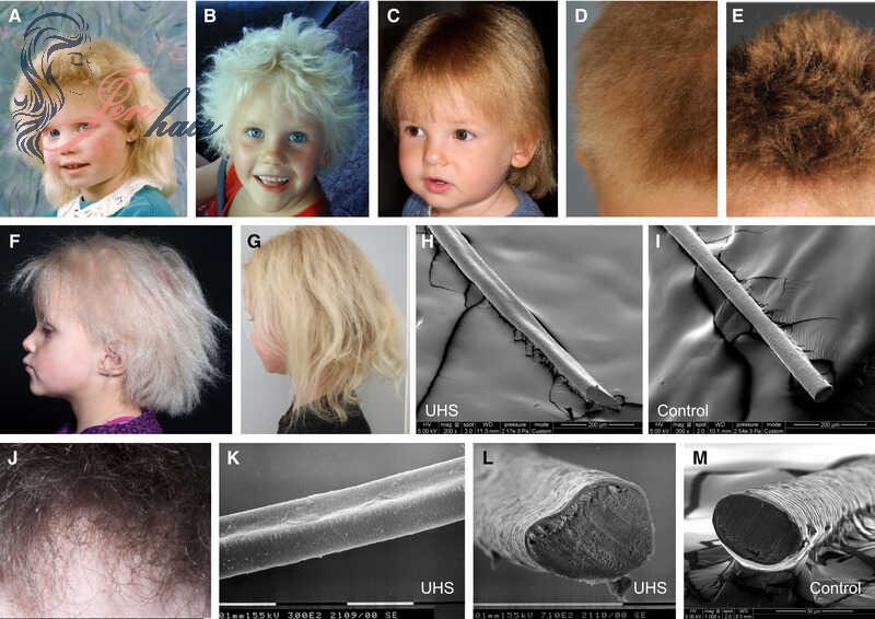 Brittleness hair can be caused by genetic makeup